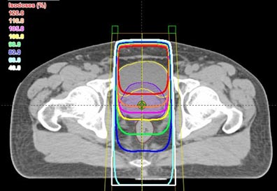 The illustration above shows what would happen if we tried to treat the prostate with a single radiation beam from the front. The yellow line is 100%, so the whole PTV receives the prescribed radiation dose. (We will keep the yellow line covering the prostate in all the subsequent pictures, for consistent comparisons.) With a single beam, most of the bladder receives 20% MORE radiation than desired. We must do better than this!