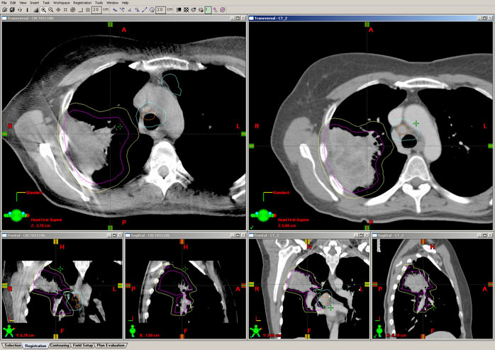 A cone-beam CT (CBCT) on the left is taken on each day of treatment to precisely line up the treatment area (lung tumor encircled by the purple line) to the scan used for planning the treatment on the right.