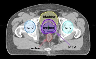 Intensity Modulated Radiation Therapy (IMRT)