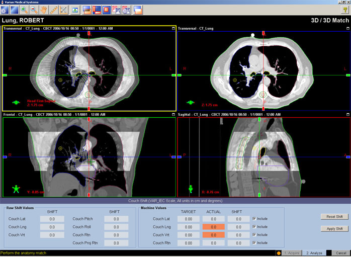 An example of an image acquisition of a cone-beam CT (CBCT) taken on the day of treatment on the Varian Trilogy® unit shows the CBCT (white) being digitally overlaid on the simulation CT scan used for treatment planning (grey). The patient is automatically moved to line up precisely with the position on the scan used for treatment planning. (courtesy of Varian)