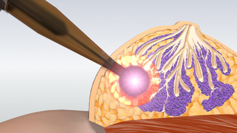 Intraoperative Radiotherapy