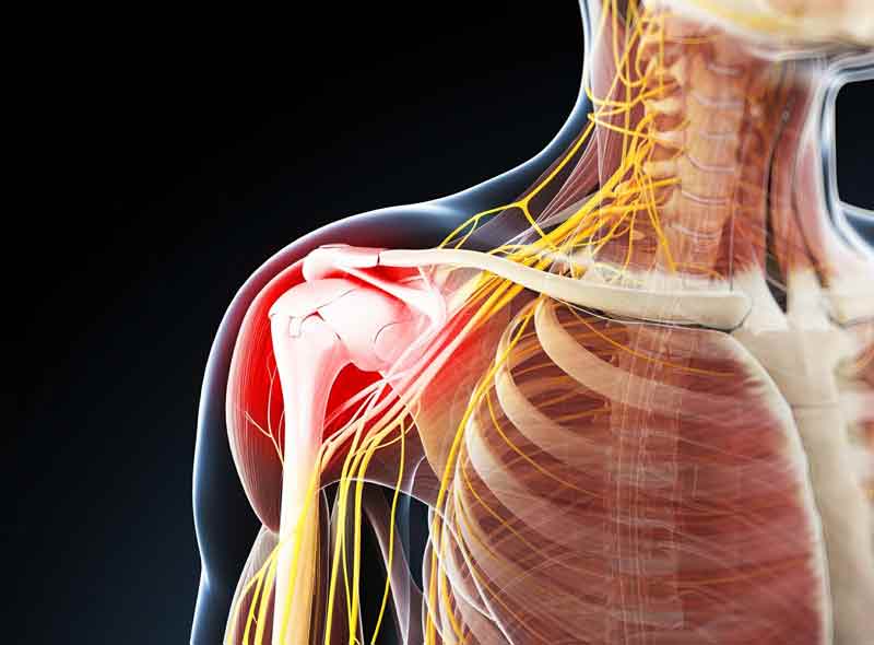 Bursitis