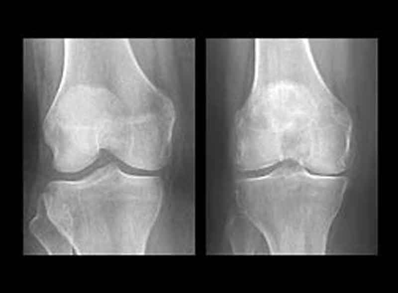 Osteoarthritis