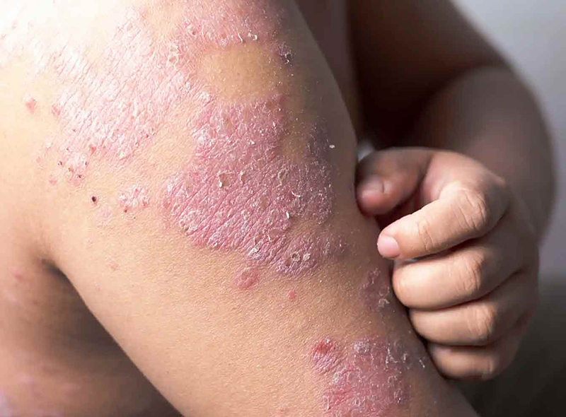 Psoriasis