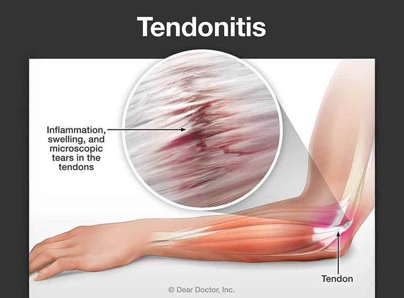 Tendonitis